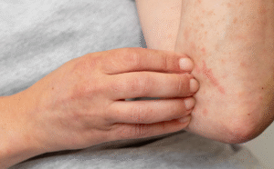 Skin_allergy_reaction_on_person_s_arm_1200x1200.png