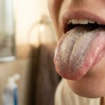 Candida Overgrowth and Sleep Issues: The Yeast-Insomnia Connection